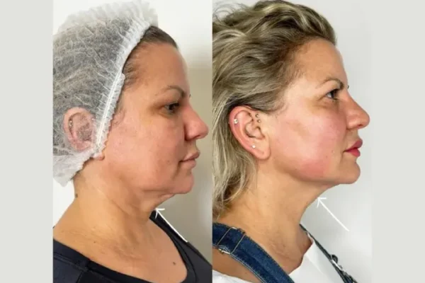 My Smooth Recovery After Endolift at the Best Aesthetic Clinic in Dubai Endolift Doctors in Dubai